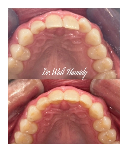 invisalign2 gallery