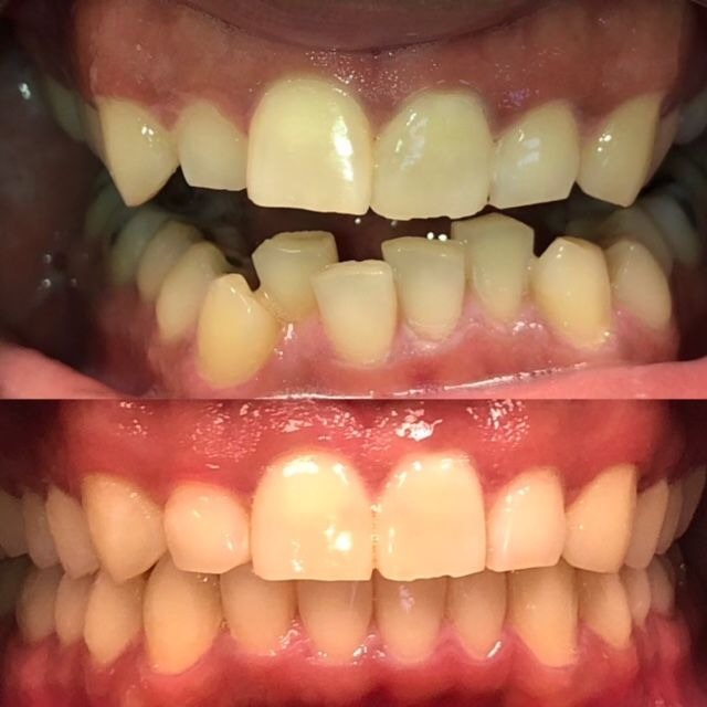 invisalign2 gallery