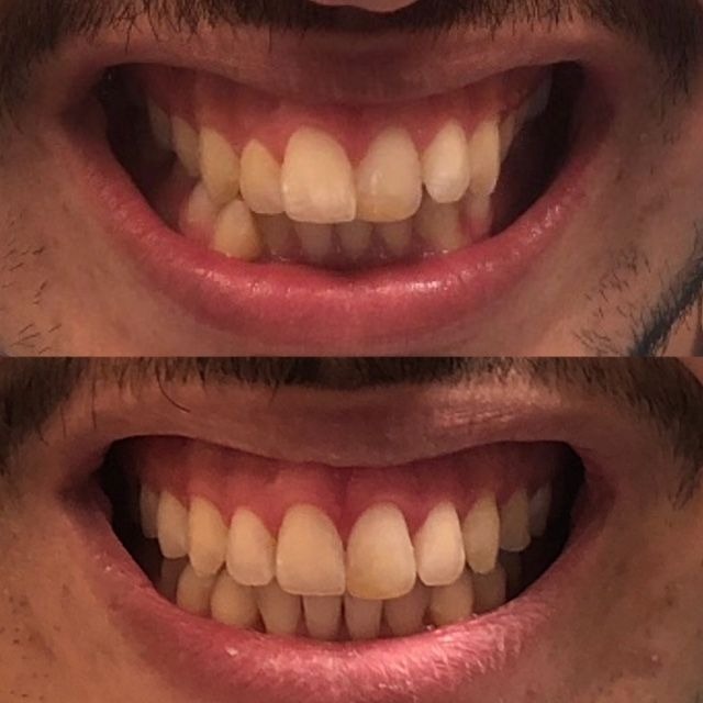 invisalign2 gallery