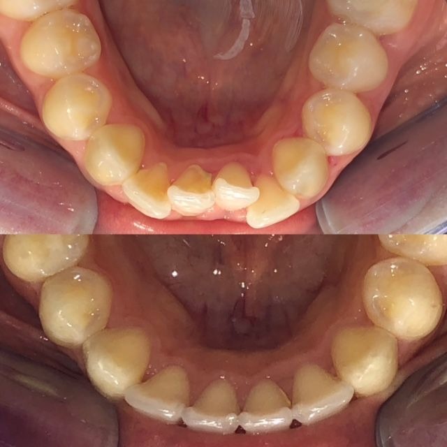 invisalign2 gallery
