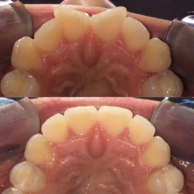 invisalign2 gallery