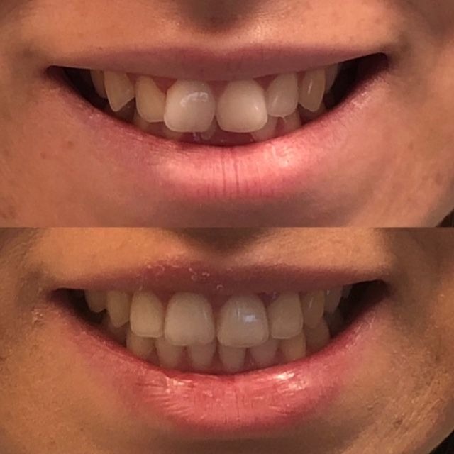 invisalign2 gallery
