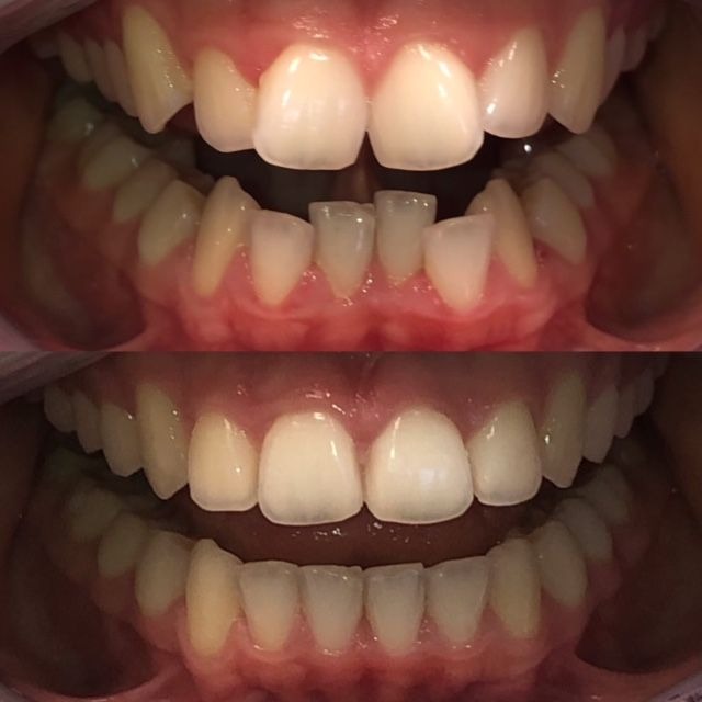 invisalign2 gallery