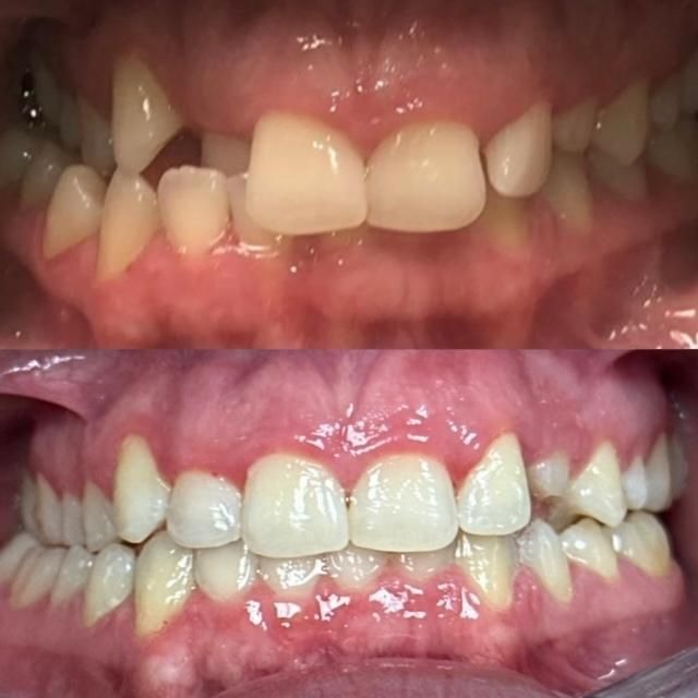 invisalign2 gallery