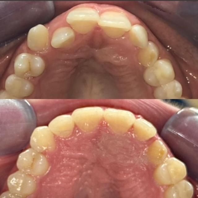 invisalign2 gallery