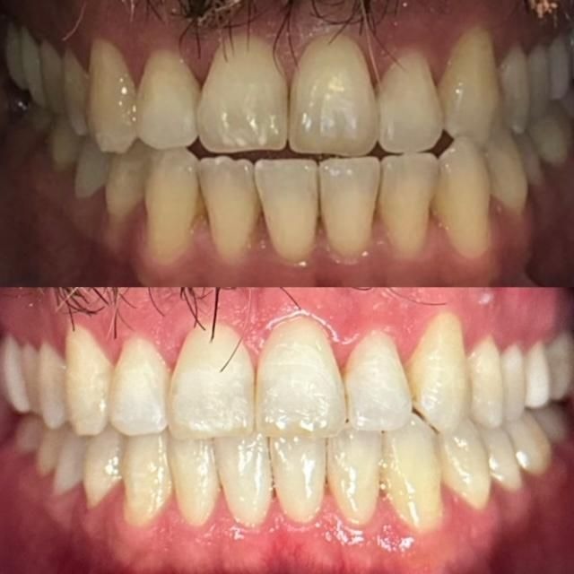 invisalign2 gallery