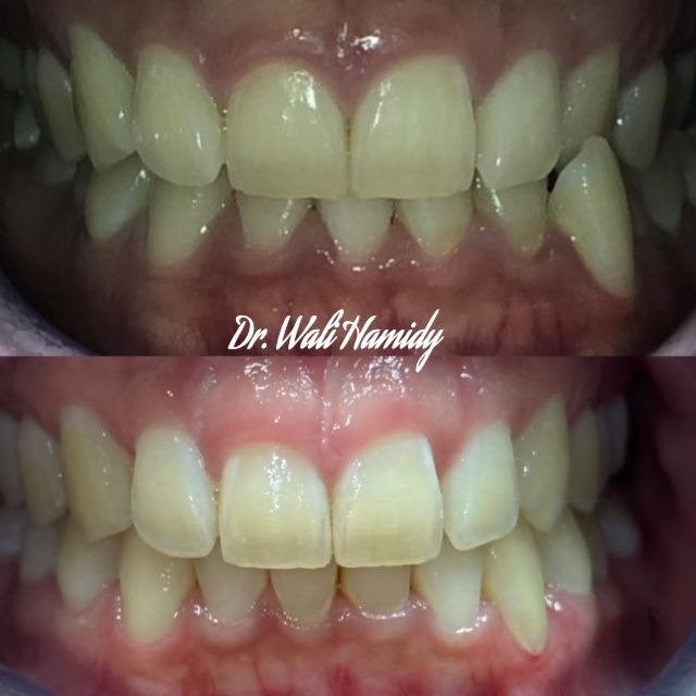 invisalign2 gallery