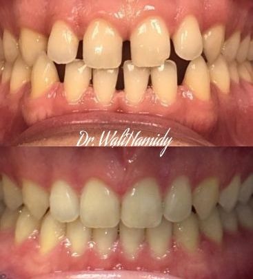 invisalign2 gallery