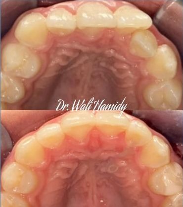 invisalign2 gallery