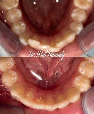 invisalign2 gallery