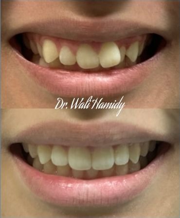 invisalign2 gallery