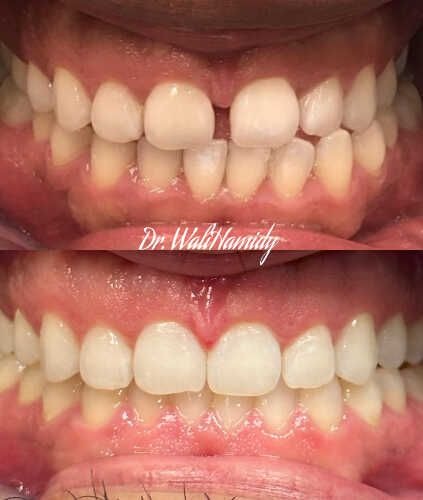 invisalign2 gallery