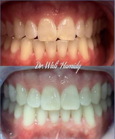 invisalign2 gallery