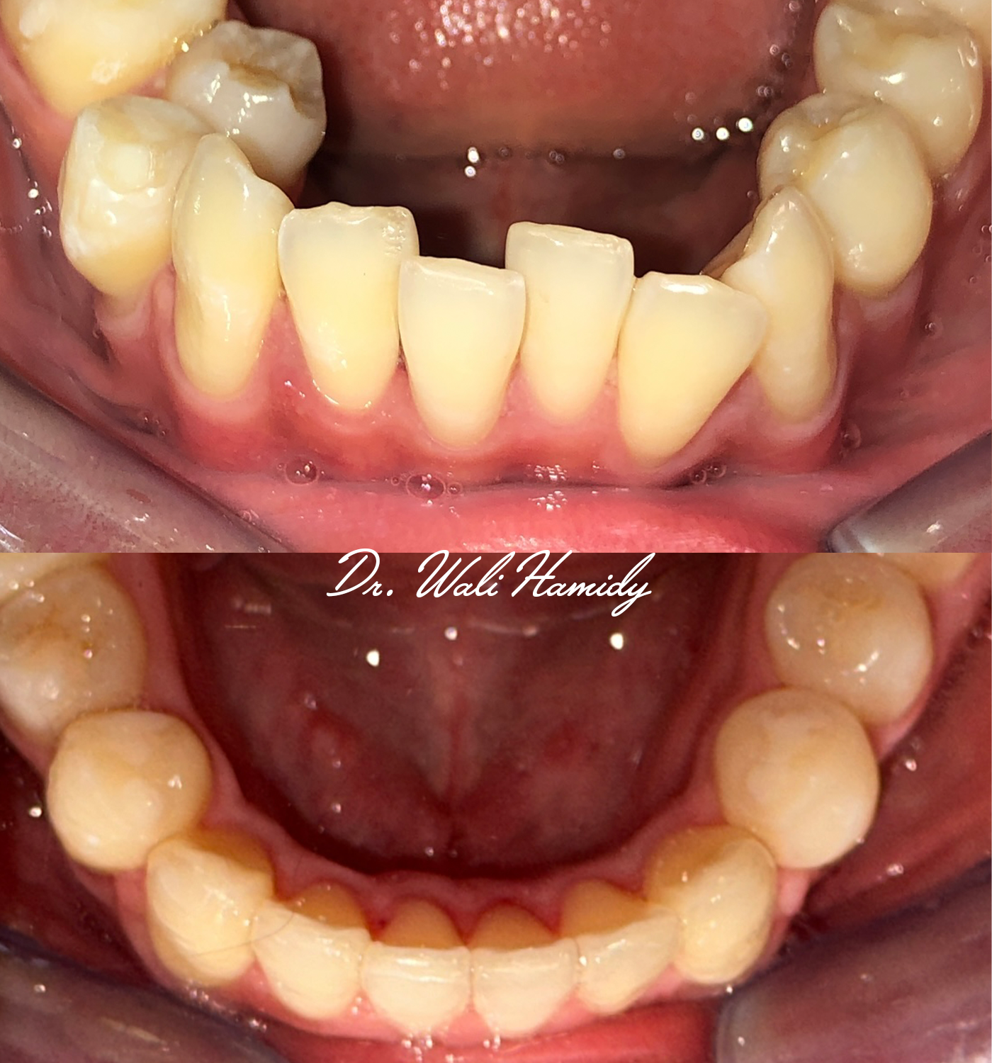 invisalign2 gallery