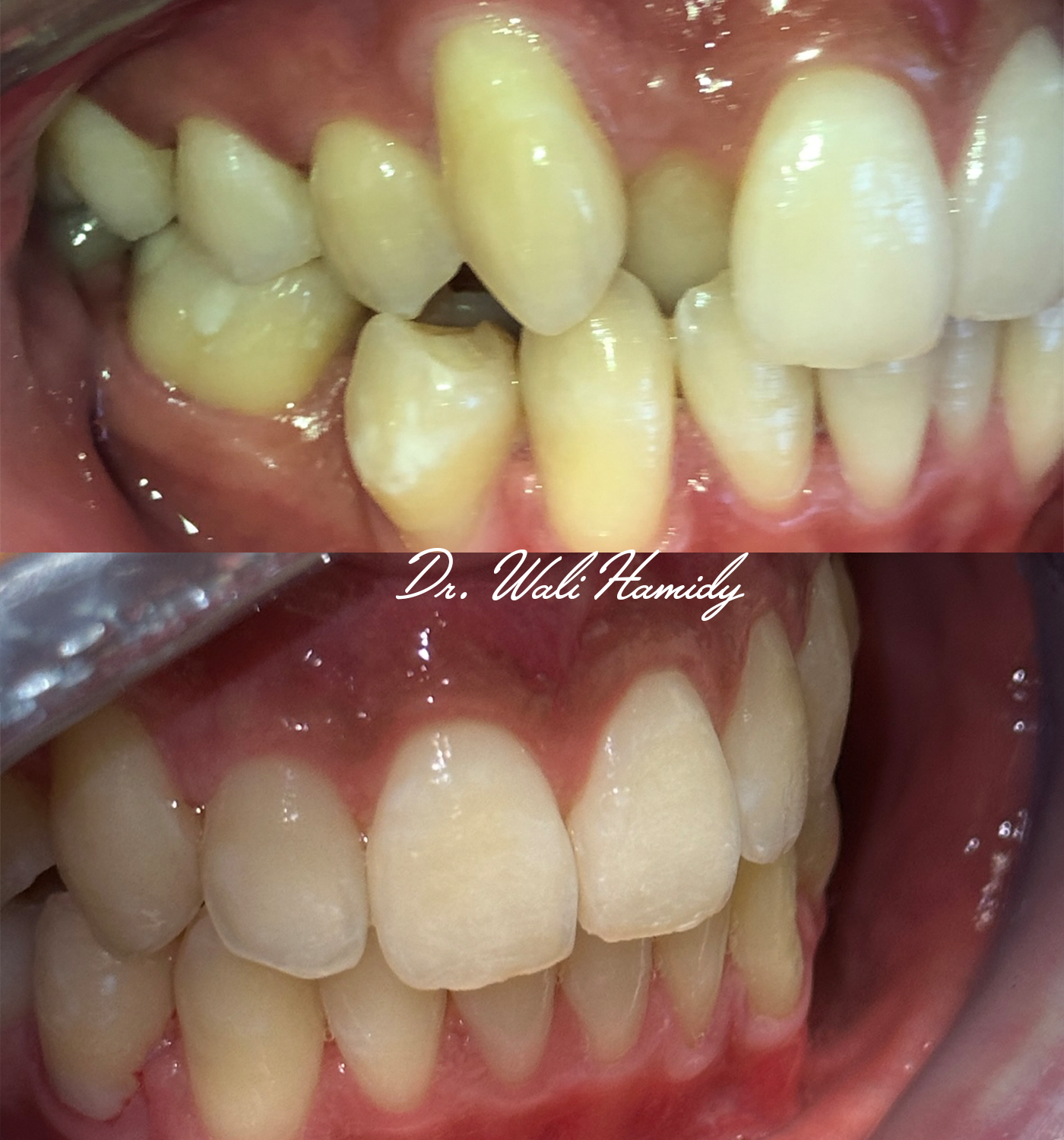 invisalign2 gallery