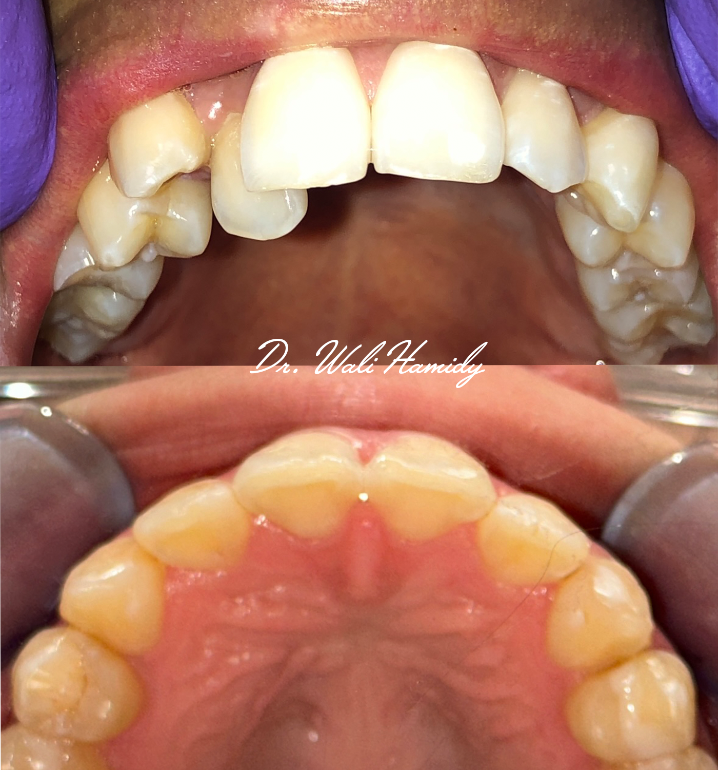 invisalign2 gallery