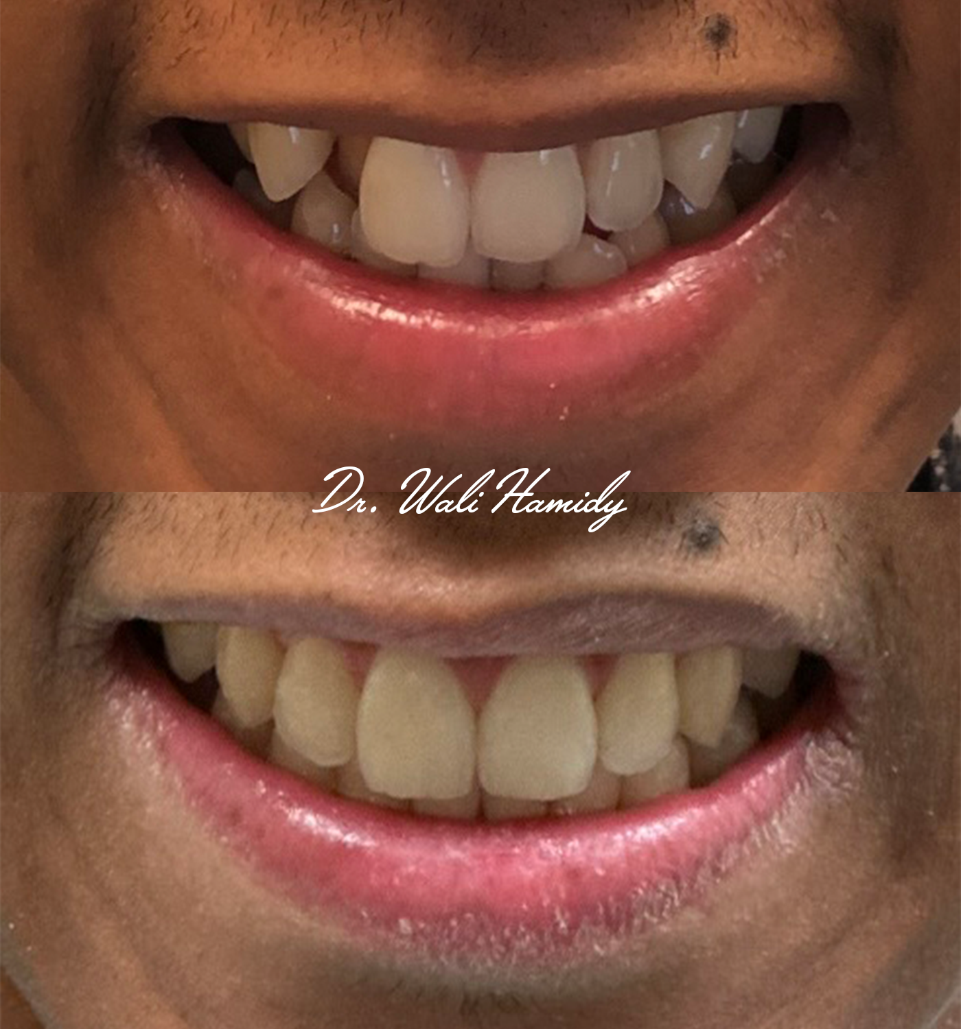 invisalign2 gallery