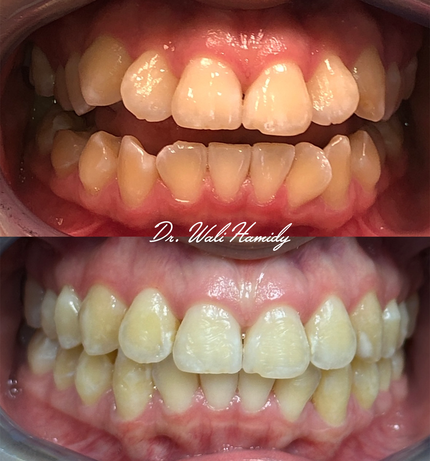 invisalign2 gallery
