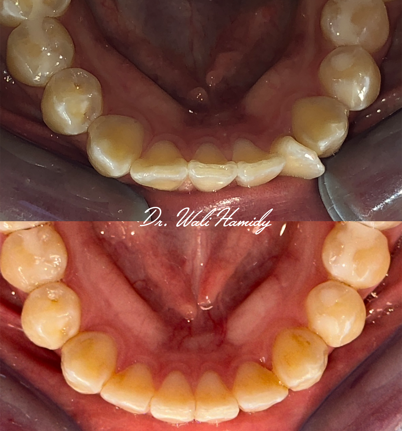 invisalign2 gallery