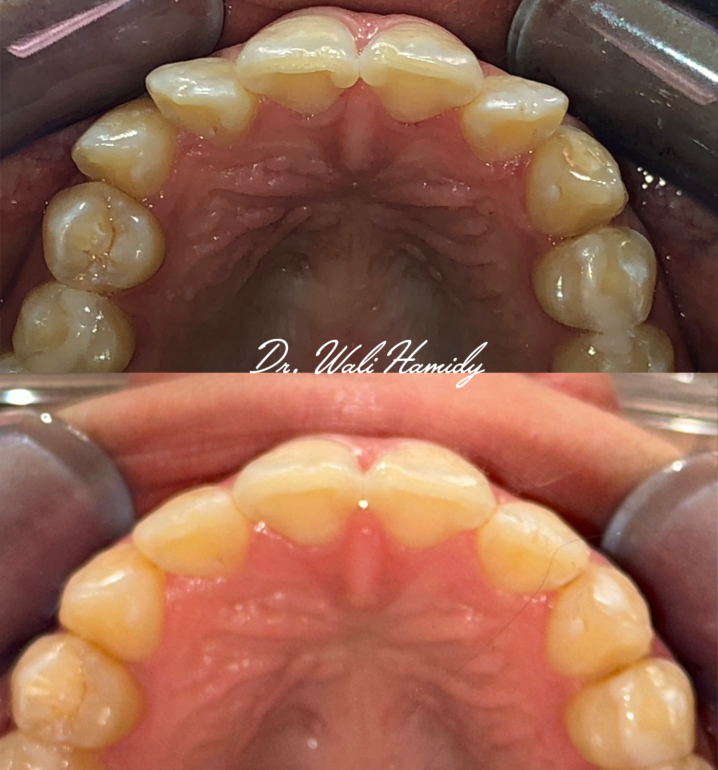 invisalign2 gallery