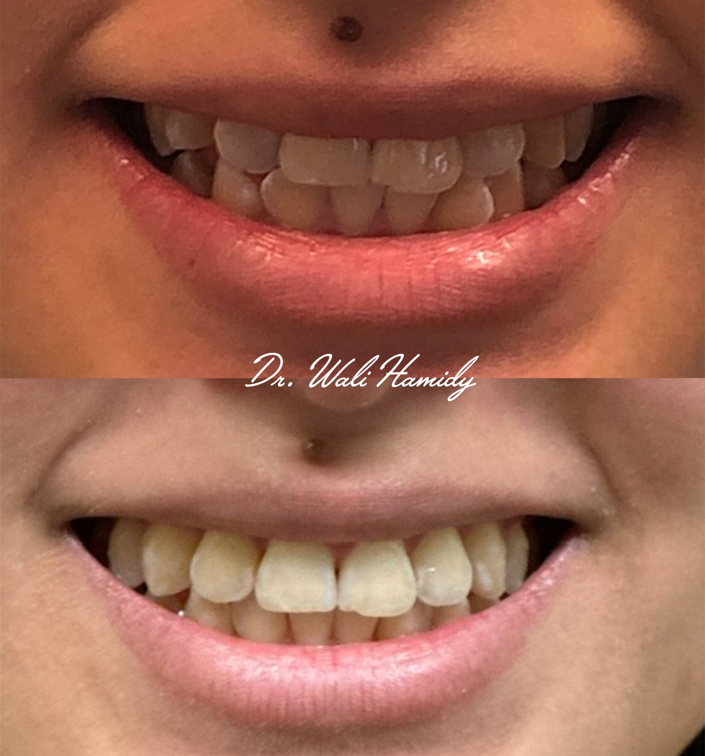 invisalign2 gallery
