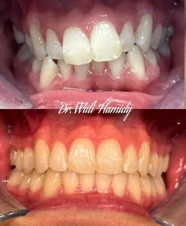 invisalign2 gallery