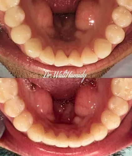 invisalign2 gallery