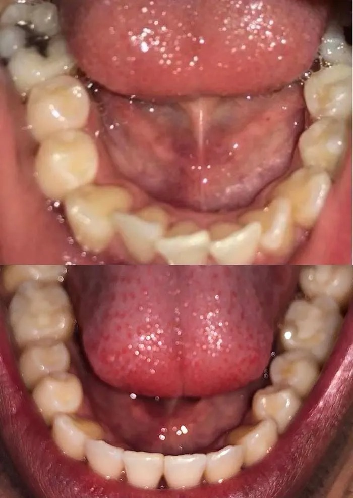 invisalign2 gallery