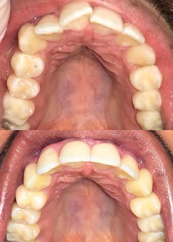 invisalign2 gallery