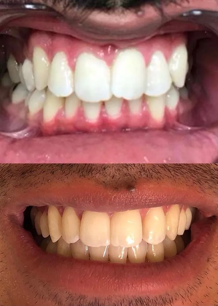 invisalign2 gallery