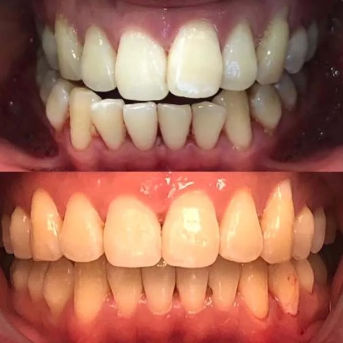 invisalign2 gallery