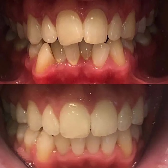 invisalign2 gallery