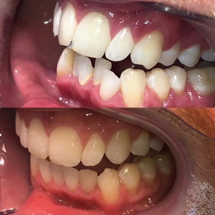 invisalign2 gallery
