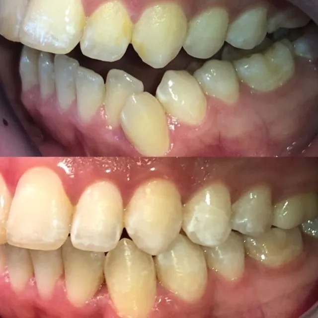 invisalign2 gallery