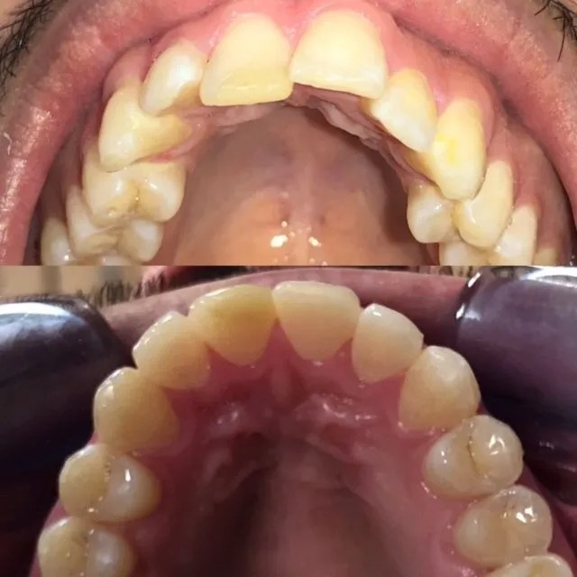 invisalign2 gallery