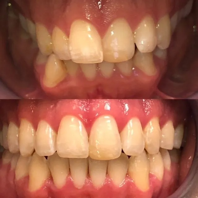 invisalign2 gallery
