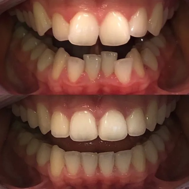invisalign2 gallery