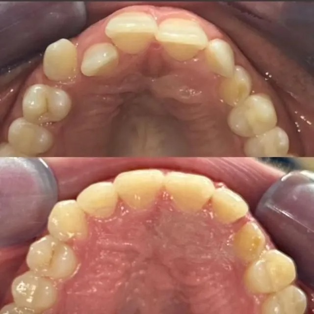 invisalign2 gallery