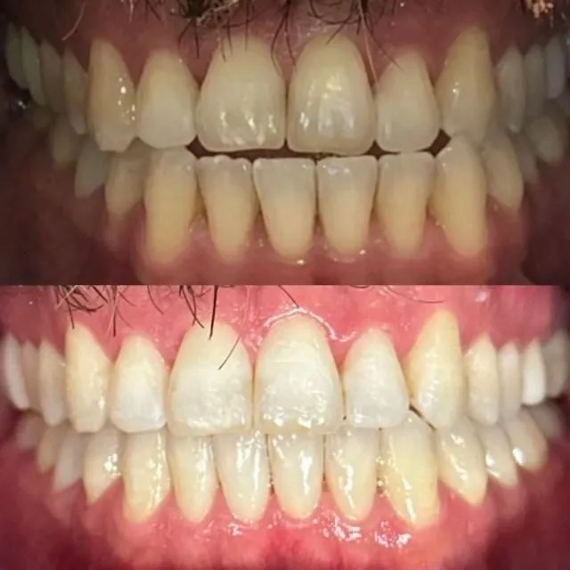 invisalign2 gallery