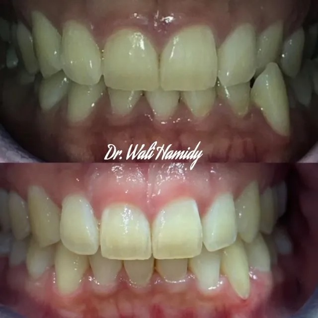 invisalign2 gallery