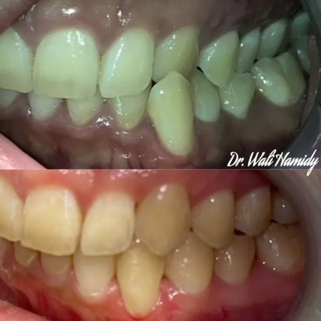 invisalign2 gallery