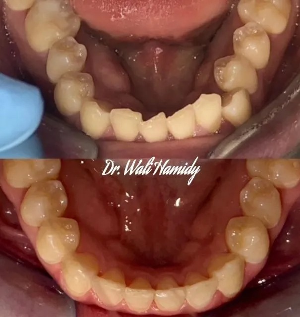 invisalign2 gallery