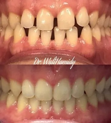 invisalign2 gallery
