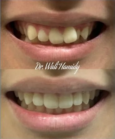 invisalign2 gallery