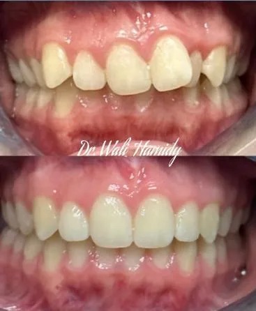 invisalign2 gallery