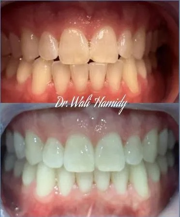 invisalign2 gallery