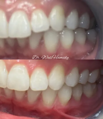 invisalign2 gallery