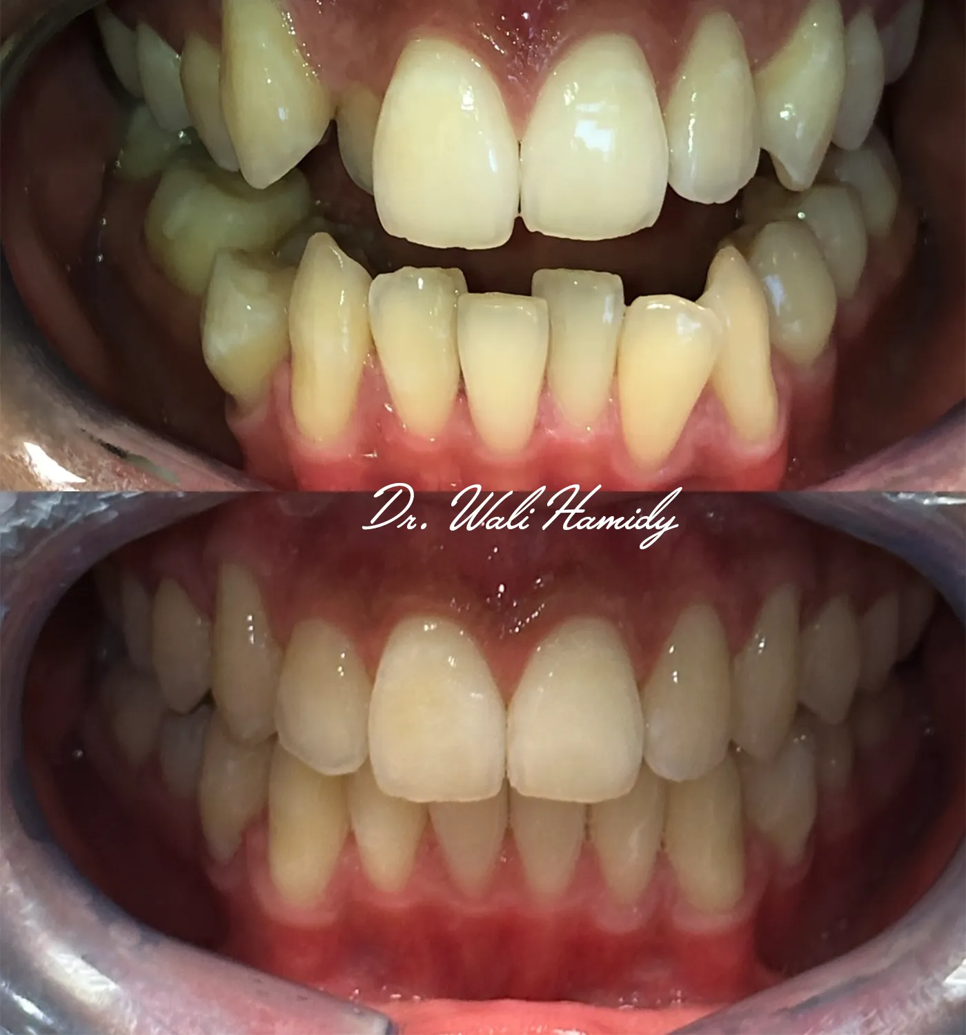 invisalign2 gallery
