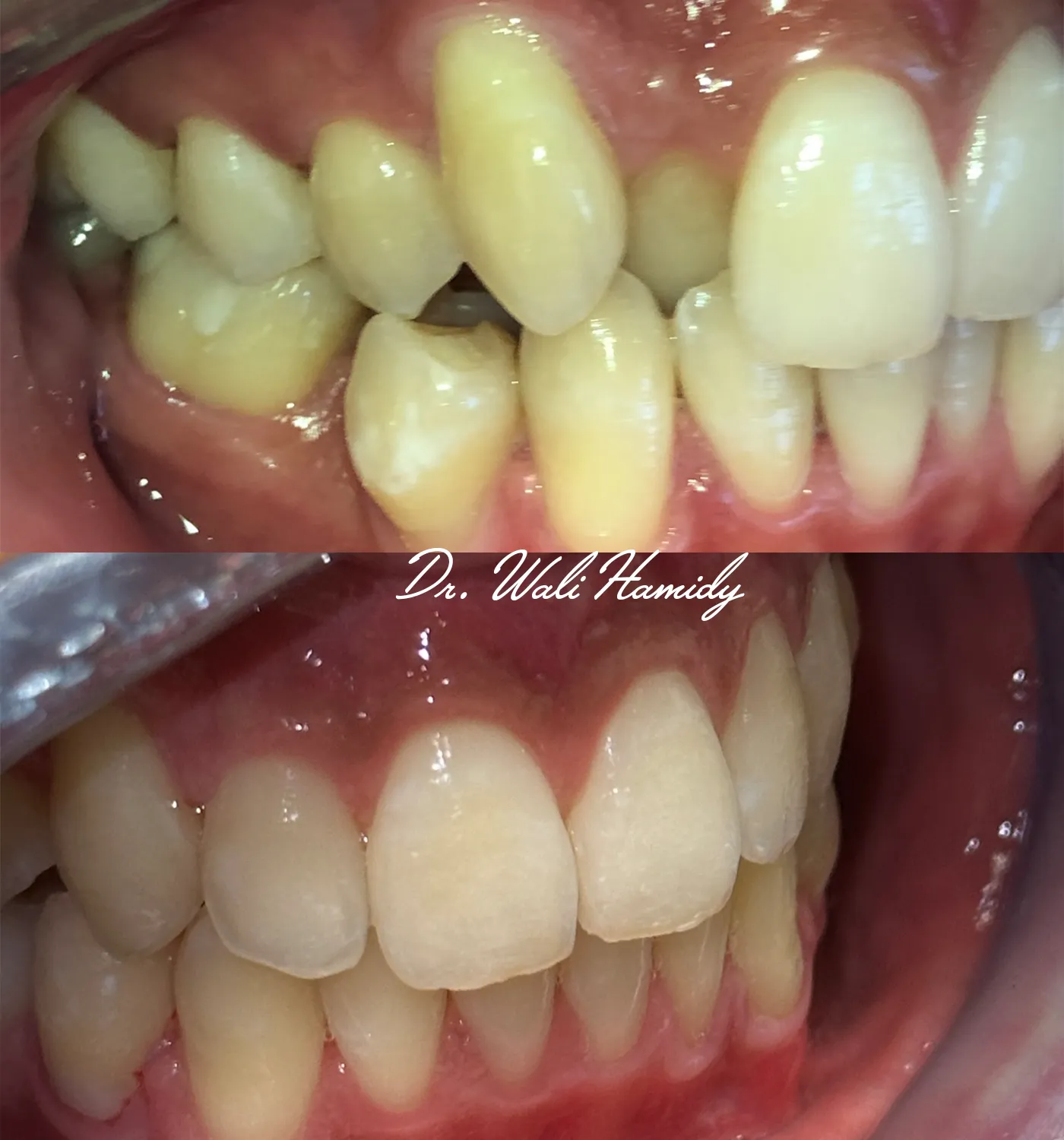 invisalign2 gallery