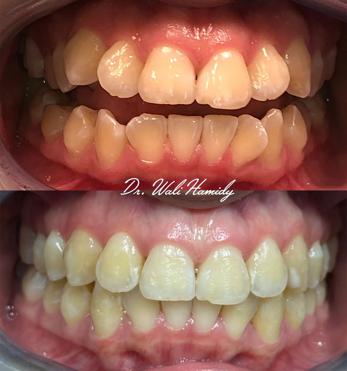 invisalign2 gallery